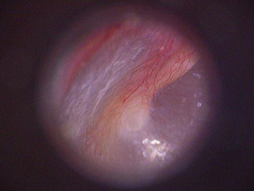 Firefly Video Otoscope